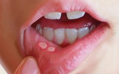 زخم‌های دردناک دهان از کجا می‌آیند؟/ دلایل شایع و راه‌های کاهش درد و پیشگیری