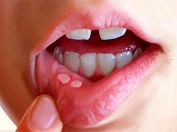 زخم‌های دردناک دهان چگونه ایجاد می شوند؟