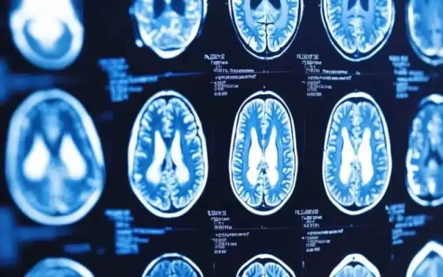 افزایش امنیت هوش مصنوعی در تحلیل MRI مغز با راه حل پژوهشگران ایرانی