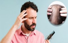علت ریزش مو چیست؟ + راه های درمان