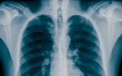 پرتوها ممکن است روند مرتبط با آلزایمر را در مغز فعال کنند