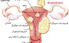 فیبروم رحمی چگونه درمان می‌شود؟ بررسی گزینه‌های دارویی، جراحی و آمبولیزاسیون