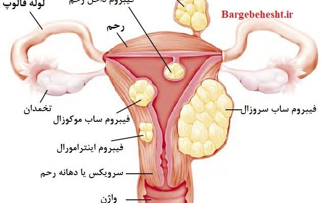 فیبروم رحمی چگونه درمان می‌شود؟ بررسی گزینه‌های دارویی، جراحی و آمبولیزاسیون