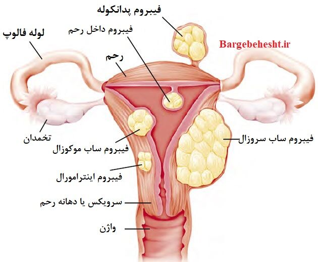 فیبروم رحمی چگونه درمان می‌شود؟ بررسی گزینه‌های دارویی، جراحی و آمبولیزاسیون