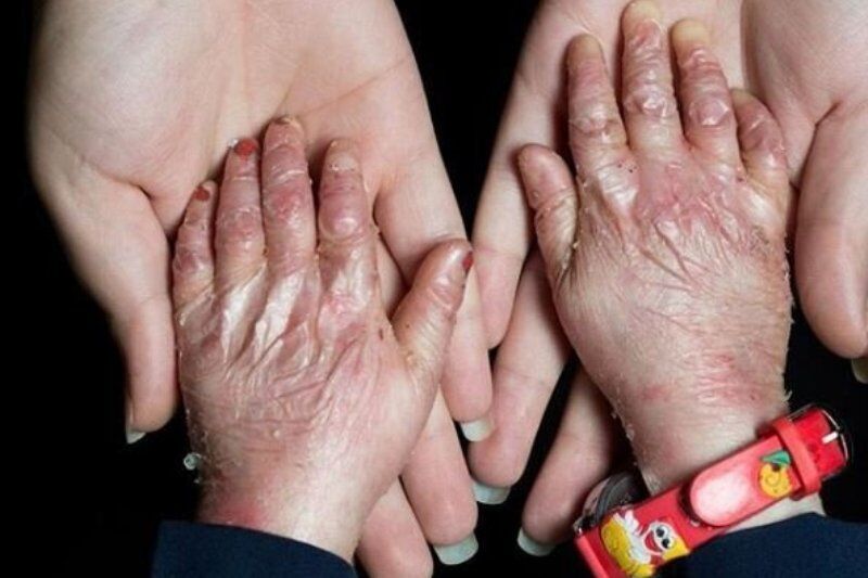 لزوم هم افزایی نهادهای متولی خوزستان برای تامین اقلام دارویی ۴۰ بیمار پروانهای