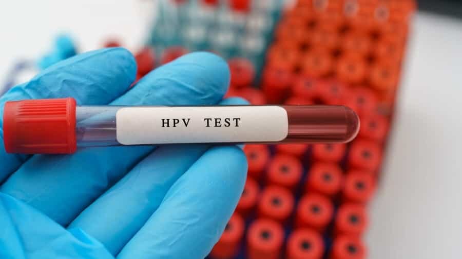 سن اچ‌پی‌وی به ۱۵ سال رسید | زنده ماندن ویروس زیر ناخن تا ۱۴ روز | اگر آزمایش HPV مثبت شد چه کنیم؟