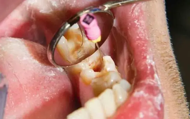آغاز ارائه خدمات عصب‌کشی با تعرفه دولتی در مراکز منتخب