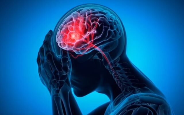 پیش‌بینی احتمال سکته مغزی با هوش مصنوعی / مدل جدید برآورد دقیق‌تری از خطر ژنتیکی ارائه می‌دهد